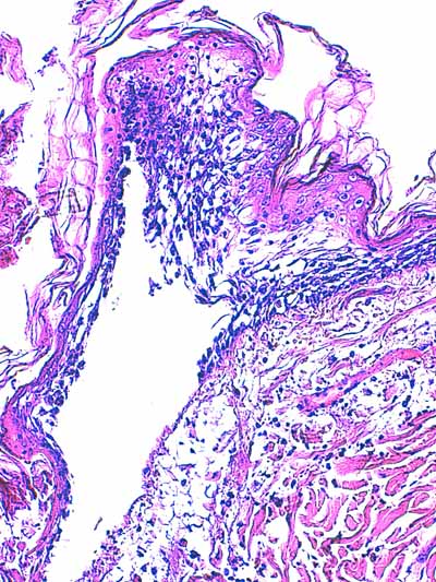 Un cas de dermo-hypodermite bactérienne nécrosante profonde à germe Gram négatif après un toilettage par épilation