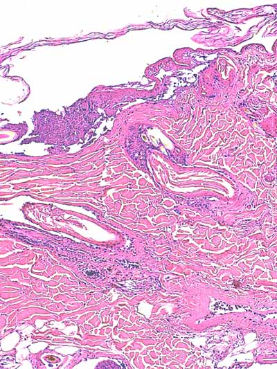 Un cas de dermo-hypodermite bactérienne nécrosante profonde à germe Gram négatif après un toilettage par épilation
