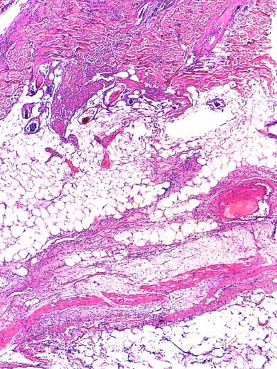 Un cas de dermo-hypodermite bactérienne nécrosante profonde à germe Gram négatif après un toilettage par épilation