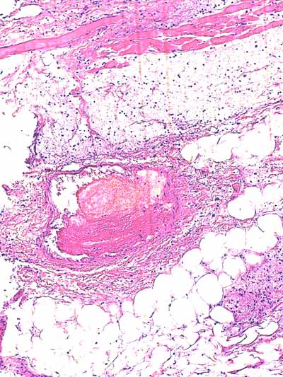 Un cas de dermo-hypodermite bactérienne nécrosante profonde à germe Gram négatif après un toilettage par épilation