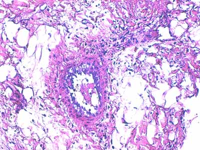 Un cas de dermo-hypodermite bactérienne nécrosante profonde à germe Gram négatif après un toilettage par épilation