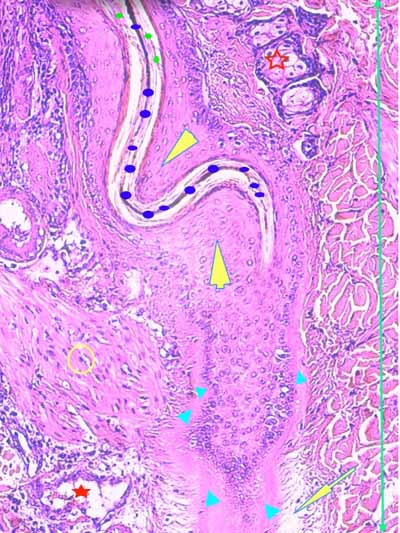 Un cas de dermo-hypodermite bactérienne nécrosante profonde à germe Gram négatif après un toilettage par épilation