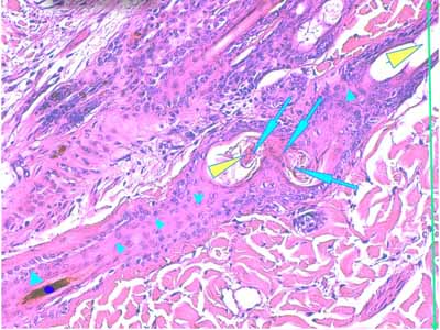 Un cas de dermo-hypodermite bactérienne nécrosante profonde à germe Gram négatif après un toilettage par épilation