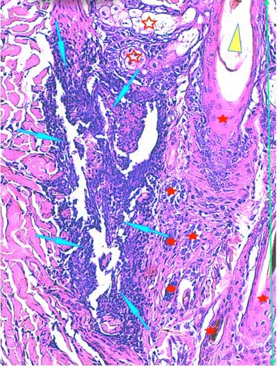 Un cas de dermo-hypodermite bactérienne nécrosante profonde à germe Gram négatif après un toilettage par épilation