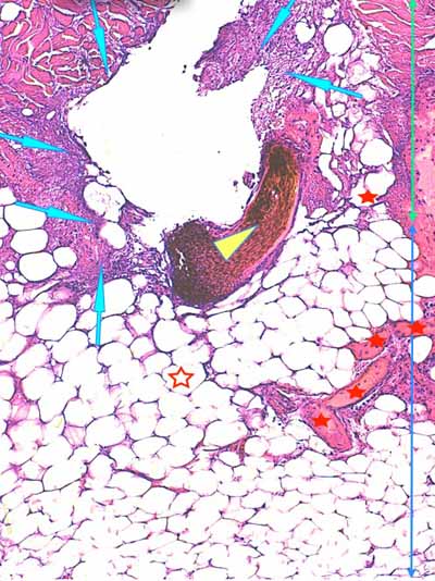 Un cas de dermo-hypodermite bactérienne nécrosante profonde à germe Gram négatif après un toilettage par épilation