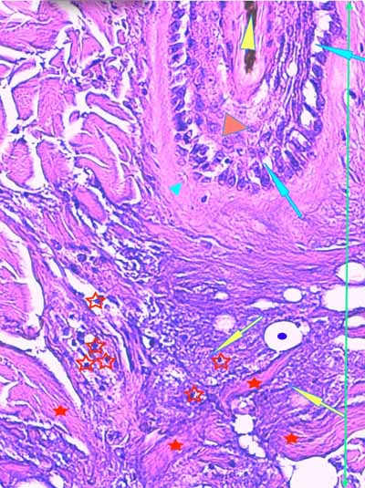 Un cas de dermo-hypodermite bactérienne nécrosante profonde à germe Gram négatif après un toilettage par épilation