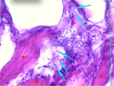 Un cas de dermo-hypodermite bactérienne nécrosante profonde à germe Gram négatif après un toilettage par épilation