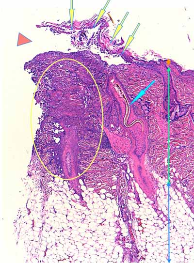 Un cas de dermo-hypodermite bactérienne nécrosante profonde à germe Gram négatif après un toilettage par épilation