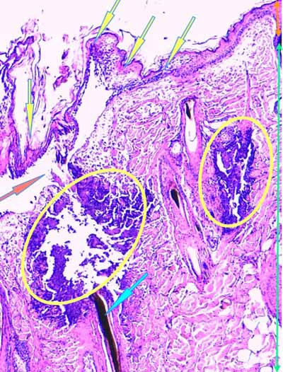 Un cas de dermo-hypodermite bactérienne nécrosante profonde à germe Gram négatif après un toilettage par épilation