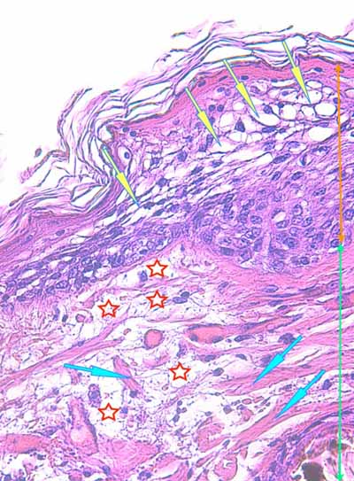 Un cas de dermo-hypodermite bactérienne nécrosante profonde à germe Gram négatif après un toilettage par épilation