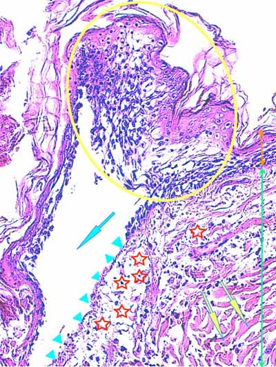 Un cas de dermo-hypodermite bactérienne nécrosante profonde à germe Gram négatif après un toilettage par épilation