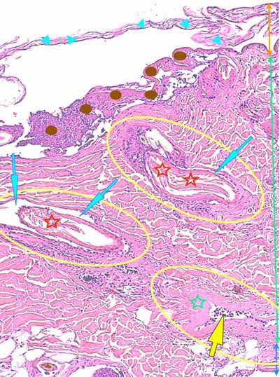 Un cas de dermo-hypodermite bactérienne nécrosante profonde à germe Gram négatif après un toilettage par épilation