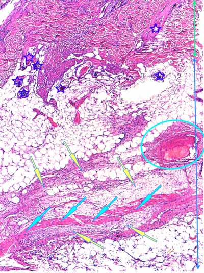 Un cas de dermo-hypodermite bactérienne nécrosante profonde à germe Gram négatif après un toilettage par épilation