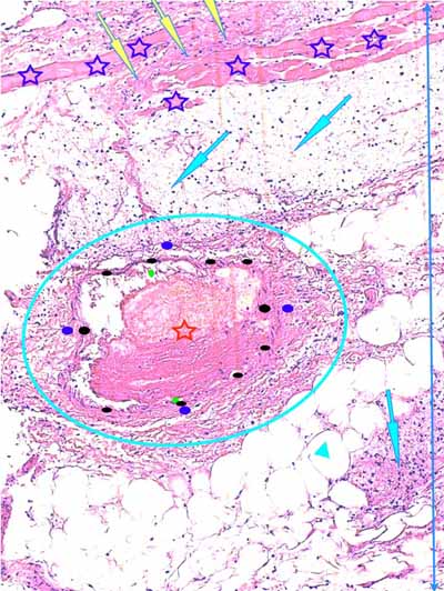 Un cas de dermo-hypodermite bactérienne nécrosante profonde à germe Gram négatif après un toilettage par épilation