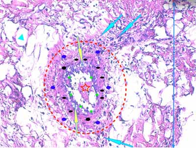 Un cas de dermo-hypodermite bactérienne nécrosante profonde à germe Gram négatif après un toilettage par épilation