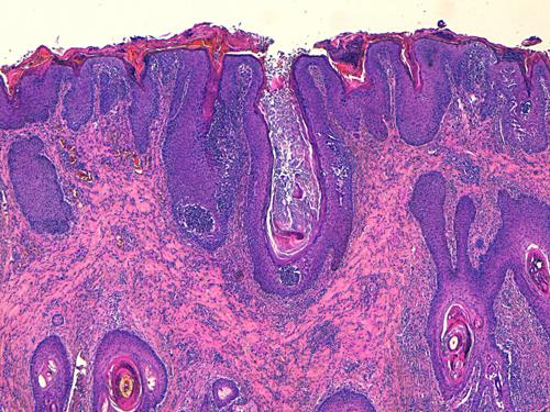 Un cas de pododermatite à ankylostomatidés chez un chien