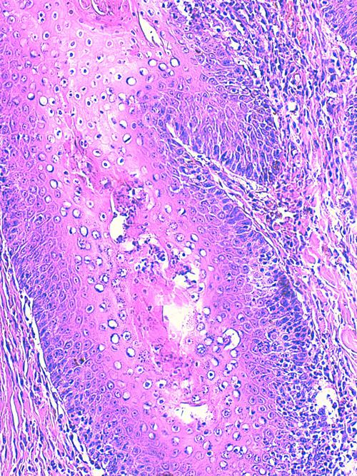 Un cas de pododermatite à ankylostomatidés chez un chien