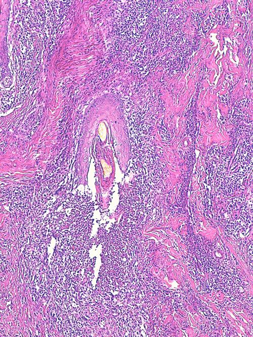 Un cas de pododermatite à ankylostomatidés chez un chien