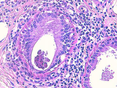 Un cas de pododermatite à ankylostomatidés chez un chien