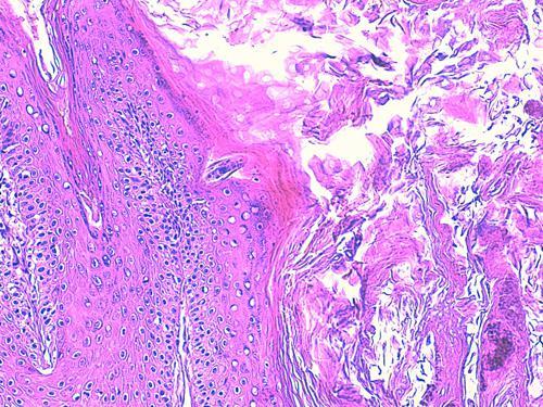 Un cas de pododermatite à ankylostomatidés chez un chien