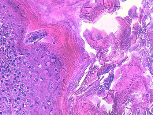 Un cas de pododermatite à ankylostomatidés chez un chien
