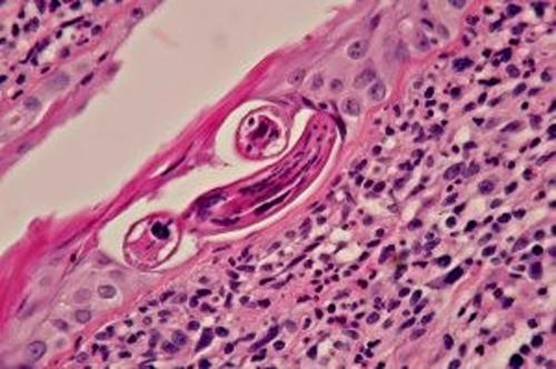 Un cas de pododermatite à ankylostomatidés chez un chien