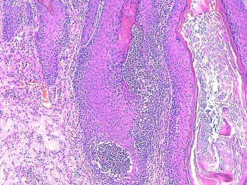Un cas de pododermatite à ankylostomatidés chez un chien