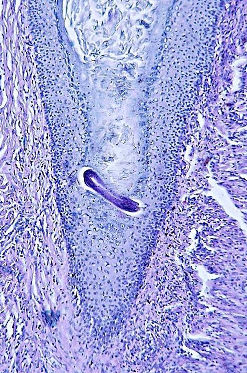 Un cas de pododermatite à ankylostomatidés chez un chien