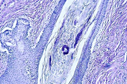 Un cas de pododermatite à ankylostomatidés chez un chien