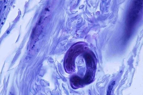 Un cas de pododermatite à ankylostomatidés chez un chien