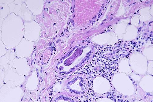 Un cas de pododermatite à ankylostomatidés chez un chien