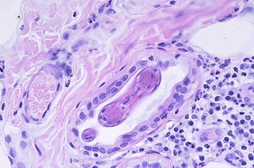 Un cas de pododermatite à ankylostomatidés chez un chien
