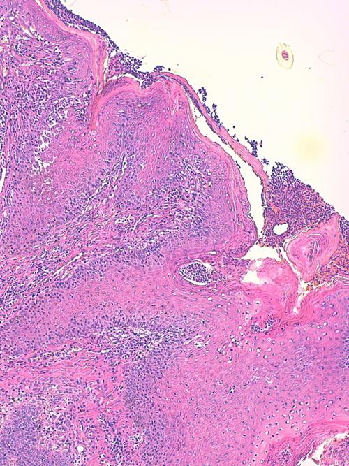 Un cas de pododermatite à ankylostomatidés chez un chien