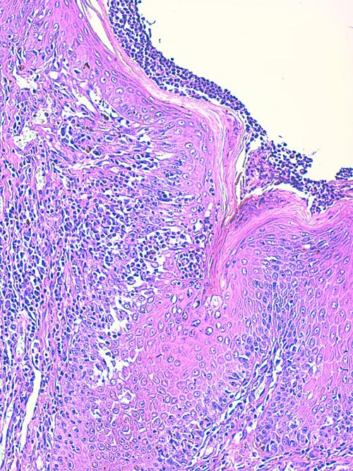 Un cas de pododermatite à ankylostomatidés chez un chien