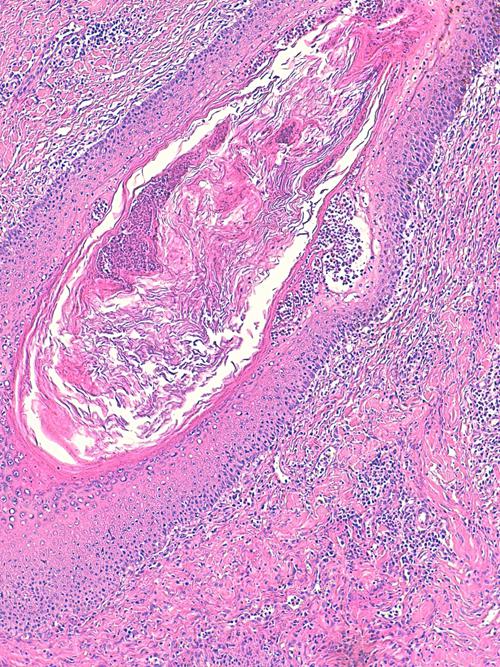 Un cas de pododermatite à ankylostomatidés chez un chien