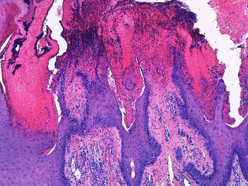 Un cas de pododermatite à ankylostomatidés chez un chien