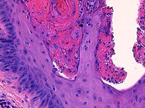 Un cas de pododermatite à ankylostomatidés chez un chien