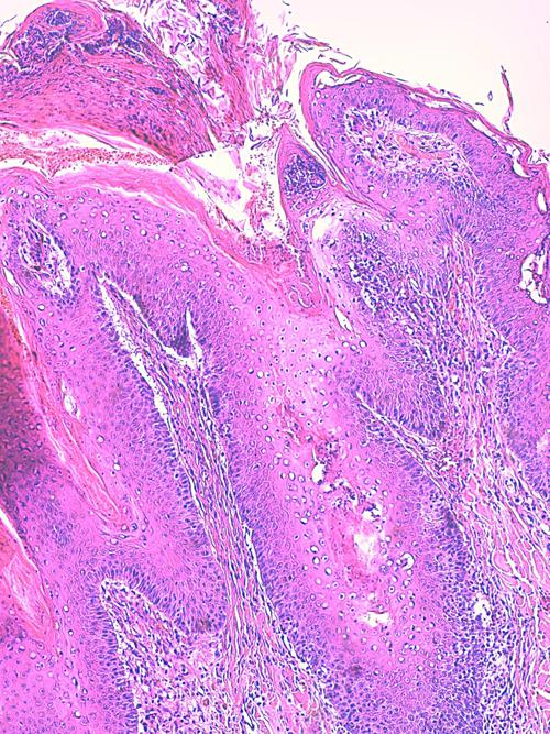 Un cas de pododermatite à ankylostomatidés chez un chien