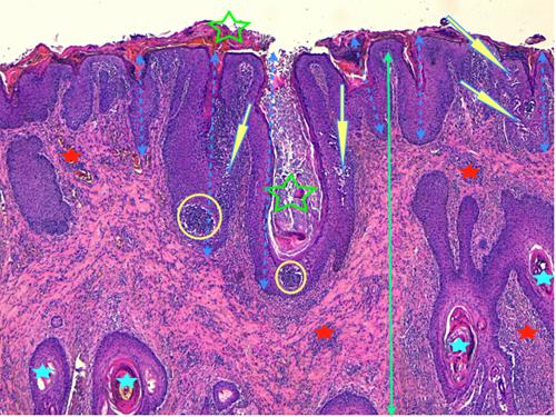 Un cas de pododermatite à ankylostomatidés chez un chien