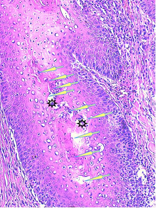 Un cas de pododermatite à ankylostomatidés chez un chien