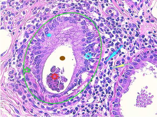Un cas de pododermatite à ankylostomatidés chez un chien
