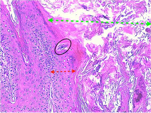 Un cas de pododermatite à ankylostomatidés chez un chien