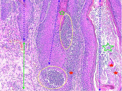 Un cas de pododermatite à ankylostomatidés chez un chien