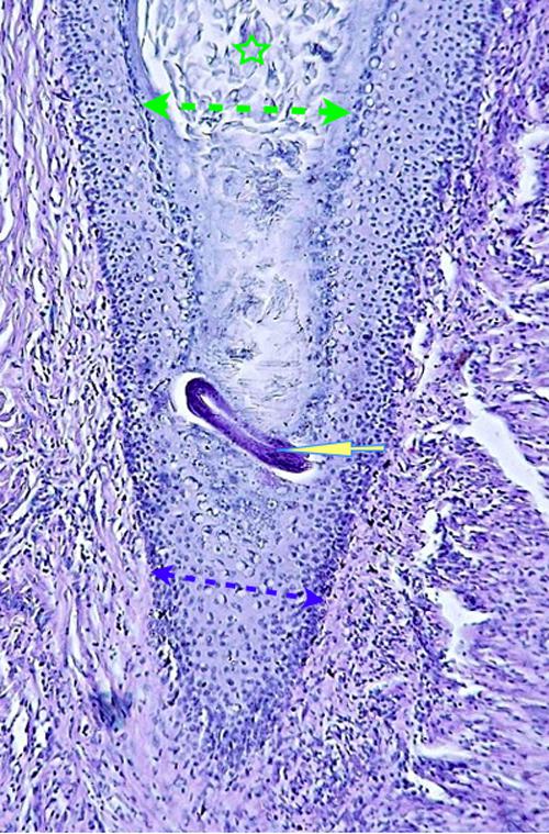 Un cas de pododermatite à ankylostomatidés chez un chien
