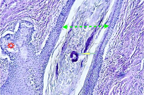 Un cas de pododermatite à ankylostomatidés chez un chien