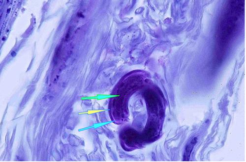 Un cas de pododermatite à ankylostomatidés chez un chien