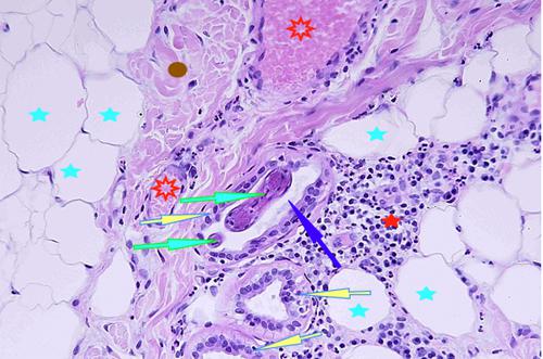 Un cas de pododermatite à ankylostomatidés chez un chien