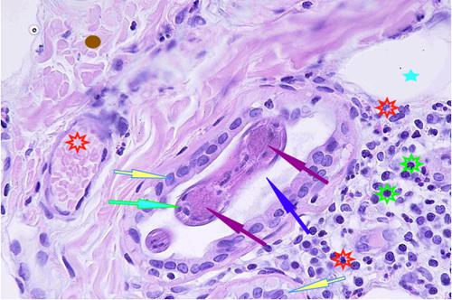 Un cas de pododermatite à ankylostomatidés chez un chien