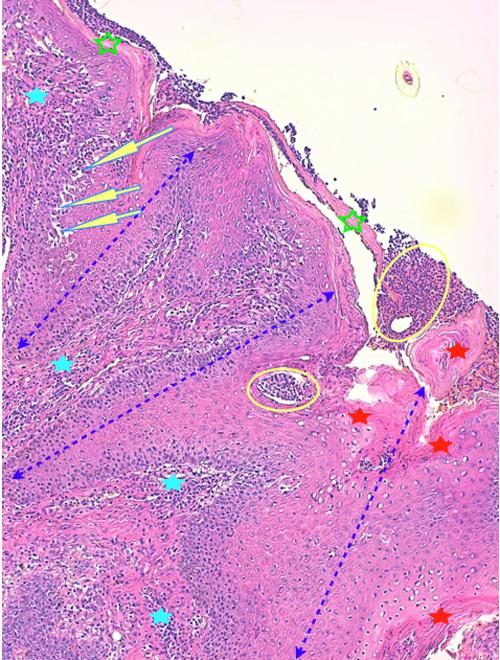 Un cas de pododermatite à ankylostomatidés chez un chien