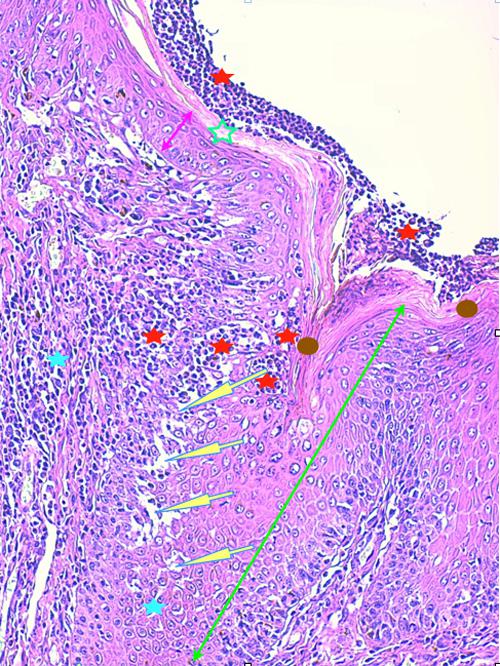 Un cas de pododermatite à ankylostomatidés chez un chien